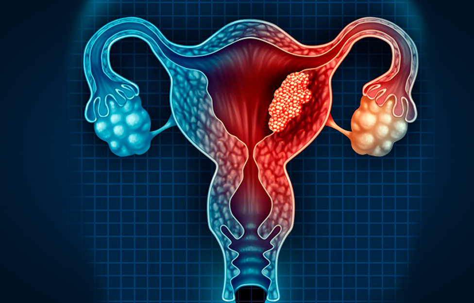 Cervical-cancer-rivera-maya-1..jpg