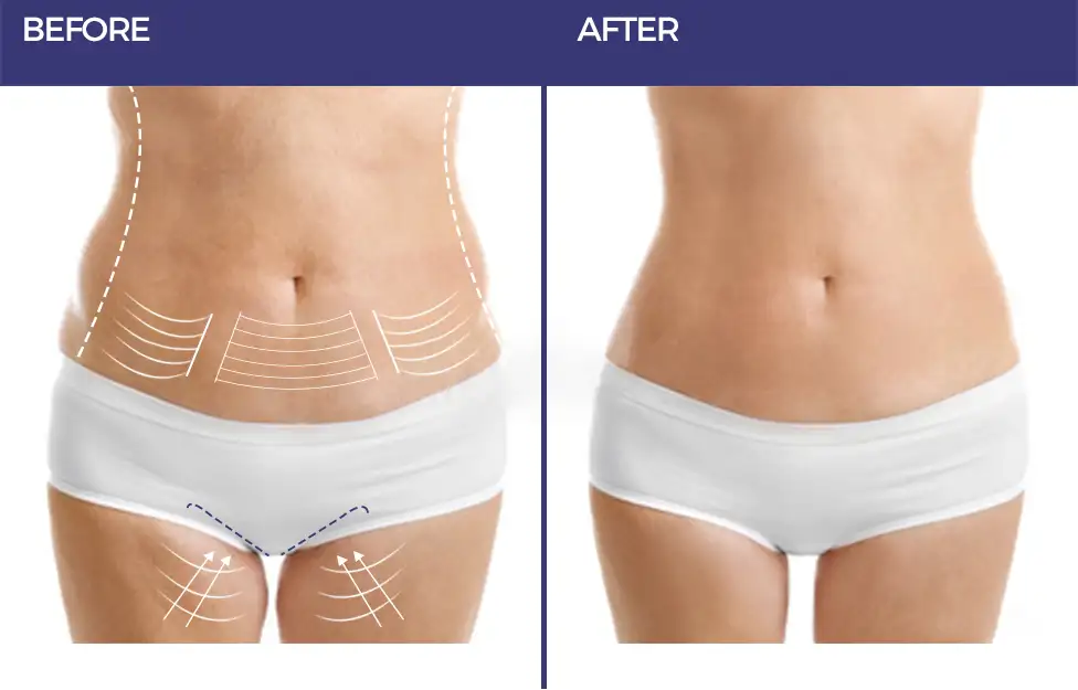 Liposuction1.jpg