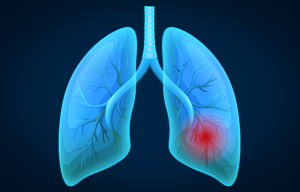 Lung-Cancer-cozumel.jpg